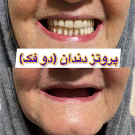 دندان مصنوعی 