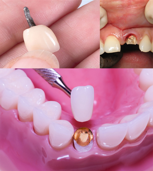 ترمیم و عصب کشی دندان 