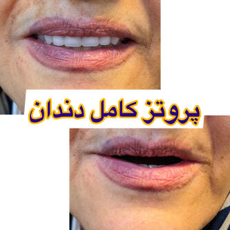 چه زمانی می توان پروتز دندان را انجام داد؟ دندان مصنوعی