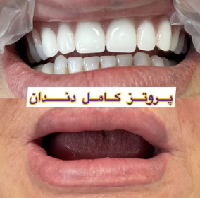 پروتز کامل دندان دست دندان