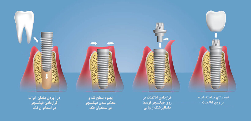 کاشت ایمپلنت دندان