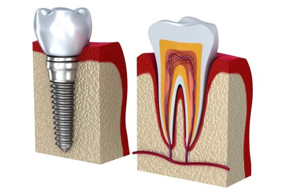 متخصص ایمپلنت