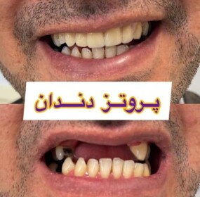 دندان مصنوعی متحرک  پروتز دندان متحرک